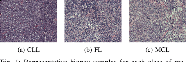 Figure 1 for Diagnosis of Malignant Lymphoma Cancer Using Hybrid Optimized Techniques Based on Dense Neural Networks