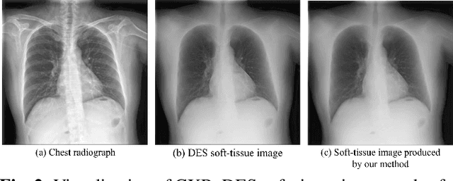 Figure 3 for BS-Diff: Effective Bone Suppression Using Conditional Diffusion Models from Chest X-Ray Images