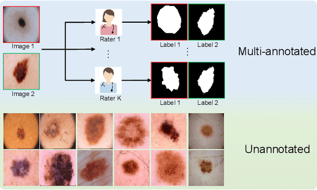 Figure 1 for MSE-Nets: Multi-annotated Semi-supervised Ensemble Networks for Improving Segmentation of Medical Image with Ambiguous Boundaries