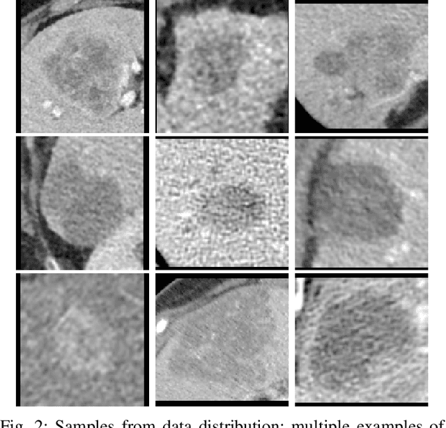 Figure 2 for Exploiting Liver CT scans in Colorectal Carcinoma genomics mutation classification