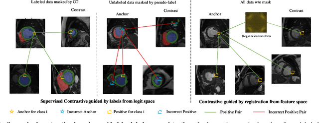 Figure 3 for Learning Semi-Supervised Medical Image Segmentation from Spatial Registration