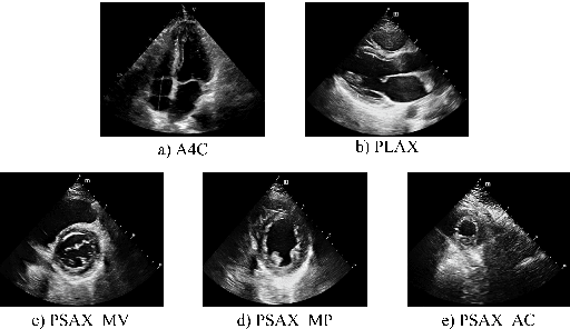 Figure 3 for A Deep Learning-Driven Pipeline for Differentiating Hypertrophic Cardiomyopathy from Cardiac Amyloidosis Using 2D Multi-View Echocardiography