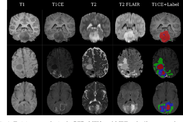 Figure 3 for Model Ensemble for Brain Tumor Segmentation in Magnetic Resonance Imaging