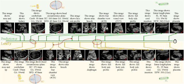 Figure 4 for MMSummary: Multimodal Summary Generation for Fetal Ultrasound Video