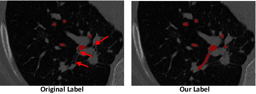 Figure 3 for Intensity Confusion Matters: An Intensity-Distance Guided Loss for Bronchus Segmentation