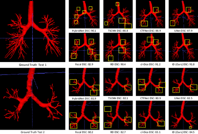 Figure 4 for Intensity Confusion Matters: An Intensity-Distance Guided Loss for Bronchus Segmentation