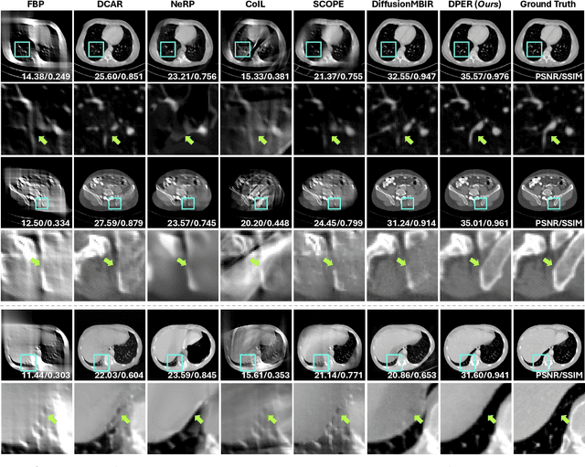 Figure 4 for DPER: Diffusion Prior Driven Neural Representation for Limited Angle and Sparse View CT Reconstruction