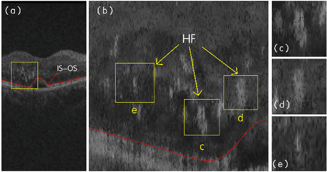 Figure 1 for Automated Quantification of Hyperreflective Foci in SD-OCT With Diabetic Retinopathy