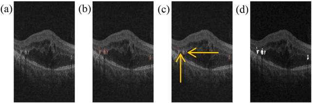 Figure 2 for Automated Quantification of Hyperreflective Foci in SD-OCT With Diabetic Retinopathy