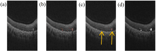 Figure 3 for Automated Quantification of Hyperreflective Foci in SD-OCT With Diabetic Retinopathy