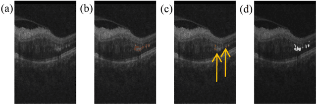 Figure 4 for Automated Quantification of Hyperreflective Foci in SD-OCT With Diabetic Retinopathy