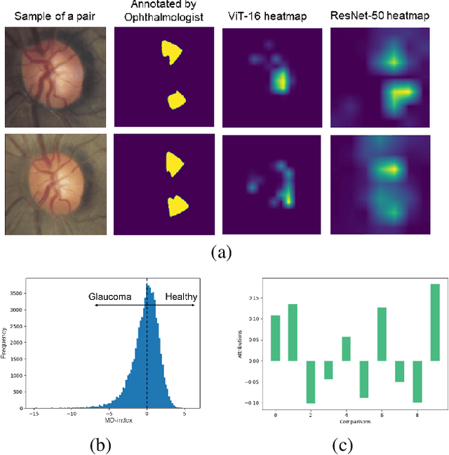 Figure 4 for Explainable Severity ranking via pairwise n-hidden comparison: a case study of glaucoma