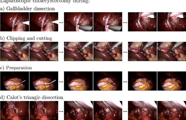 Figure 1 for SurGen: Text-Guided Diffusion Model for Surgical Video Generation