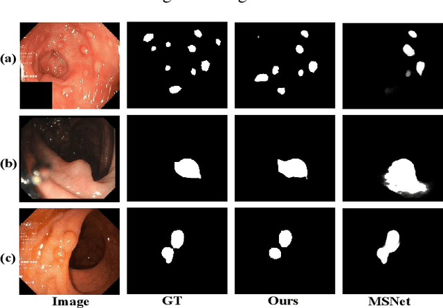 Figure 1 for PSTNet: Enhanced Polyp Segmentation with Multi-scale Alignment and Frequency Domain Integration