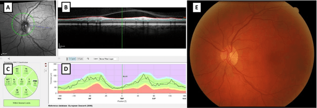 Figure 2 for A method for quantifying sectoral optic disc pallor in fundus photographs and its association with peripapillary RNFL thickness