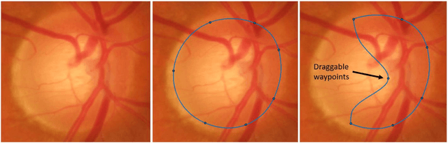 Figure 4 for A method for quantifying sectoral optic disc pallor in fundus photographs and its association with peripapillary RNFL thickness