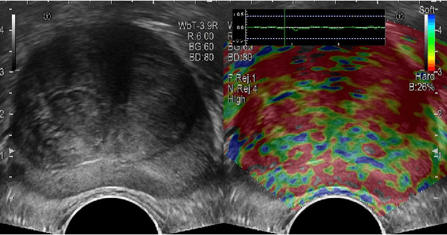 Figure 1 for Multi-modality transrectal ultrasound video classification for identification of clinically significant prostate cancer