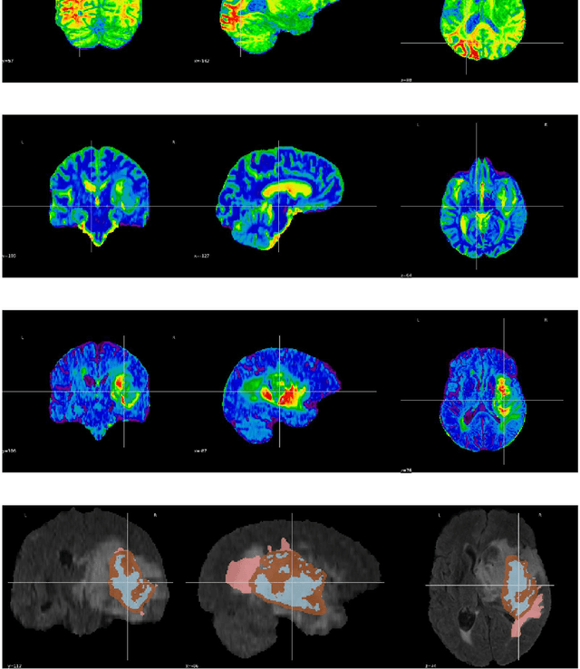 Figure 3 for An Integrated Deep Learning Framework for Effective Brain Tumor Localization, Segmentation, and Classification from Magnetic Resonance Images