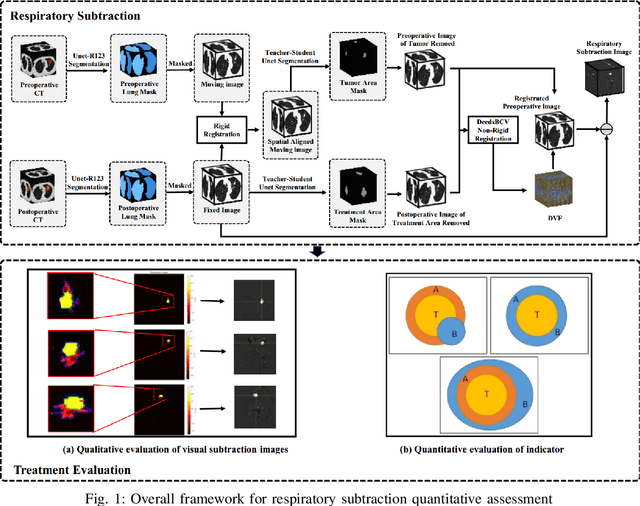 Figure 1 for Respiratory Subtraction for Pulmonary Microwave Ablation Evaluation