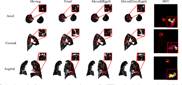 Figure 4 for Respiratory Subtraction for Pulmonary Microwave Ablation Evaluation