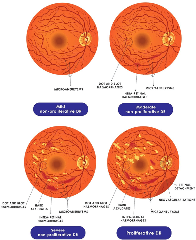 Figure 4 for Artificial Intelligence and Diabetes Mellitus: An Inside Look Through the Retina