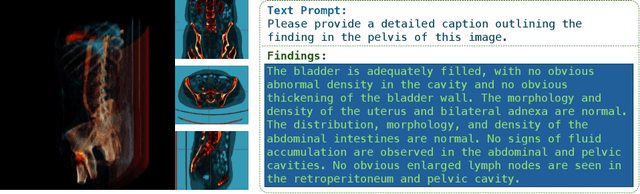 Figure 1 for ViT3D Alignment of LLaMA3: 3D Medical Image Report Generation