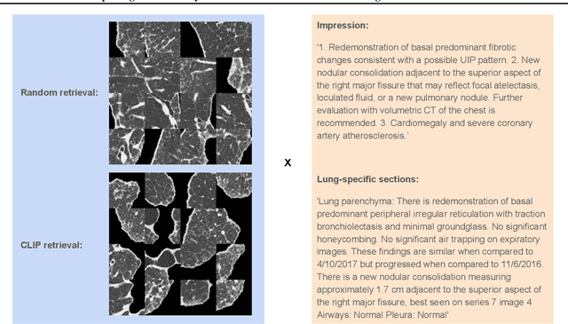 Figure 2 for Exploring the Versatility of Zero-Shot CLIP for Interstitial Lung Disease Classification