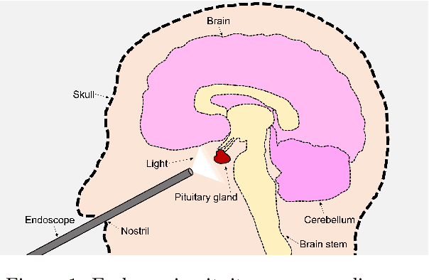 Figure 1 for PitVis-2023 Challenge: Workflow Recognition in videos of Endoscopic Pituitary Surgery