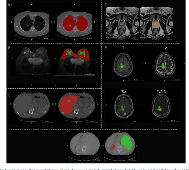 Figure 3 for AI generated annotations for Breast, Brain, Liver, Lungs and Prostate cancer collections in National Cancer Institute Imaging Data Commons