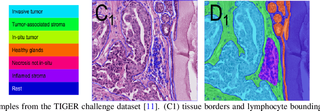 Figure 1 for Optimizing Lymphocyte Detection in Breast Cancer Whole Slide Imaging through Data-Centric Strategies