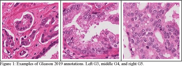 Figure 1 for Segmentation Strategies in Deep Learning for Prostate Cancer Diagnosis: A Comparative Study of Mamba, SAM, and YOLO