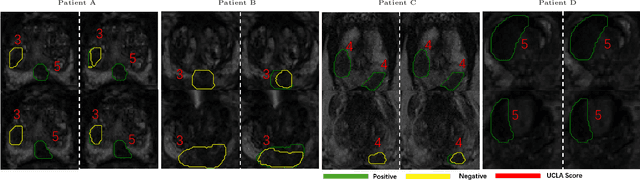 Figure 4 for AI-assisted prostate cancer detection and localisation on biparametric MR by classifying radiologist-positives