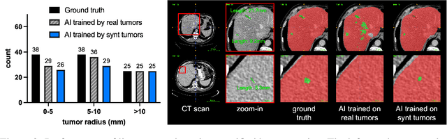 Figure 2 for Synthetic Tumors Make AI Segment Tumors Better