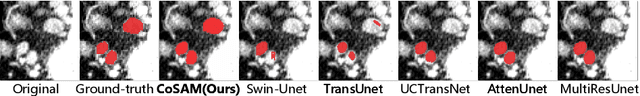 Figure 4 for Meply: A Large-scale Dataset and Baseline Evaluations for Metastatic Perirectal Lymph Node Detection and Segmentation