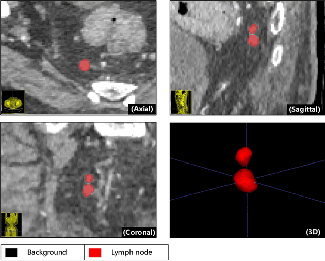 Figure 1 for Meply: A Large-scale Dataset and Baseline Evaluations for Metastatic Perirectal Lymph Node Detection and Segmentation