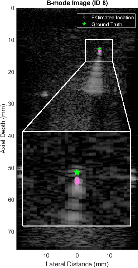 Figure 4 for A Radiological Clip Design Using Ultrasound Identification to Improve Localization