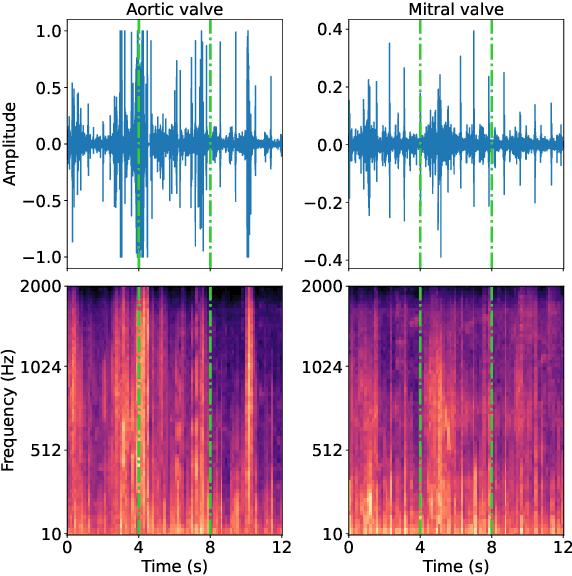 Figure 3 for Dual Bayesian ResNet: A Deep Learning Approach to Heart Murmur Detection