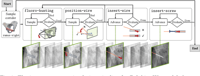 Figure 3 for Pelphix: Surgical Phase Recognition from X-ray Images in Percutaneous Pelvic Fixation