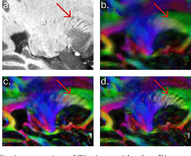 Figure 4 for Image Quality Transfer of Diffusion MRI Guided By High-Resolution Structural MRI