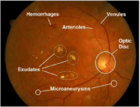 Figure 3 for Explainable AI: Comparative Analysis of Normal and Dilated ResNet Models for Fundus Disease Classification