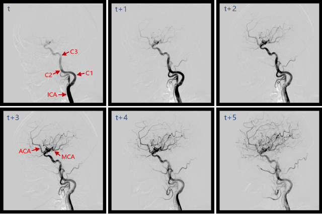 Figure 1 for DIAS: A Comprehensive Benchmark for DSA-sequence Intracranial Artery Segmentation