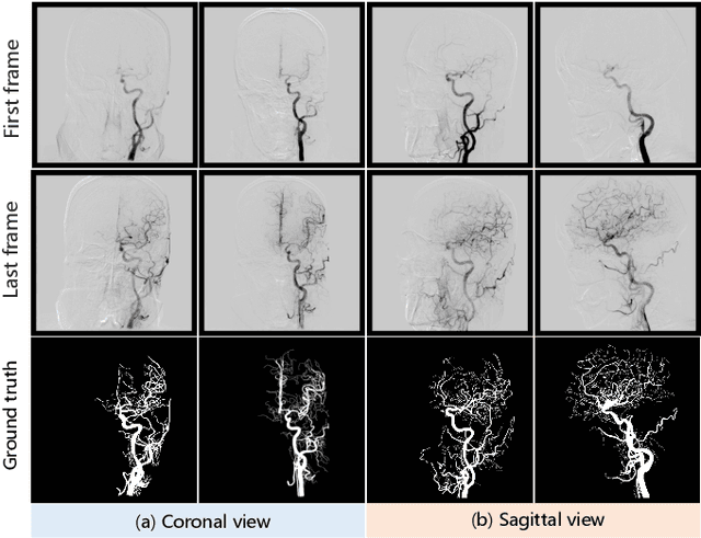 Figure 3 for DIAS: A Comprehensive Benchmark for DSA-sequence Intracranial Artery Segmentation