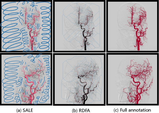 Figure 4 for DIAS: A Comprehensive Benchmark for DSA-sequence Intracranial Artery Segmentation