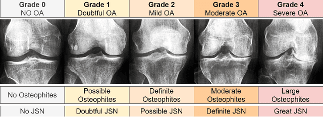 Figure 3 for Synthesizing Bidirectional Temporal States of Knee Osteoarthritis Radiographs with Cycle-Consistent Generative Adversarial Neural Networks