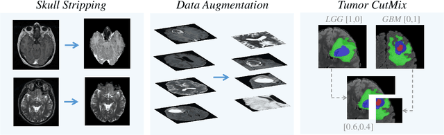 Figure 1 for Glioma Multimodal MRI Analysis System for Tumor Layered Diagnosis via Multi-task Semi-supervised Learning