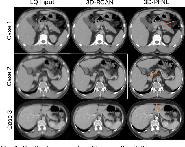 Figure 2 for Leveraging Multiphase CT for Quality Enhancement of Portal Venous CT: Utility for Pancreas Segmentation