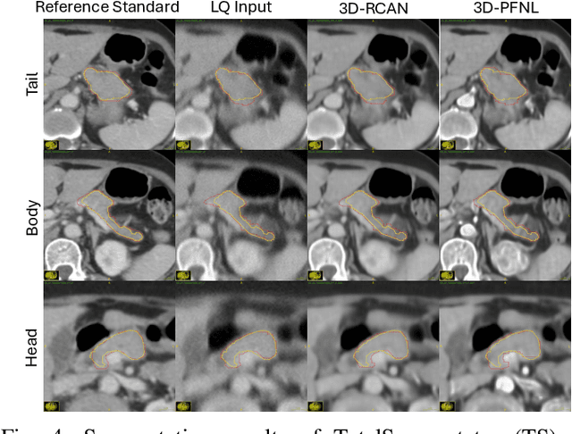 Figure 4 for Leveraging Multiphase CT for Quality Enhancement of Portal Venous CT: Utility for Pancreas Segmentation