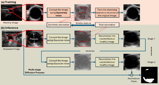 Figure 1 for Synomaly Noise and Multi-Stage Diffusion: A Novel Approach for Unsupervised Anomaly Detection in Ultrasound Imaging