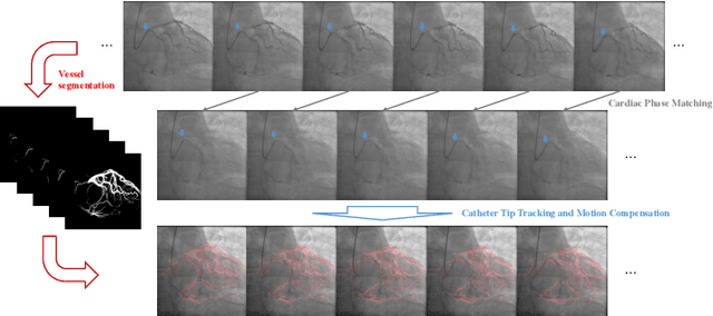 Figure 1 for Auxiliary Input in Training: Incorporating Catheter Features into Deep Learning Models for ECG-Free Dynamic Coronary Roadmapping