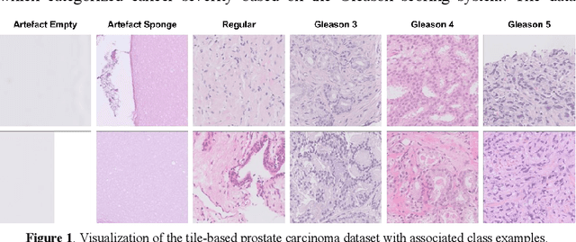 Figure 1 for Assessing the Performance of Deep Learning for Automated Gleason Grading in Prostate Cancer